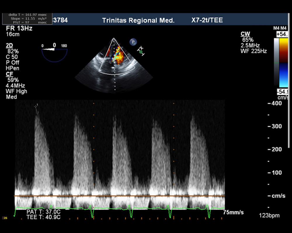 TEE continuous-wave Doppler across aortic valve showing severe aortic regurgitation with p1/2 time 97 ms.
