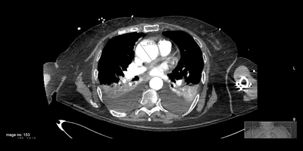 CT aortogram showing ascending aorta measuring 4.6 cm.