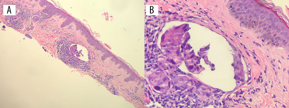 (A, B) Left abdominal skin biopsy demonstrating unremarkable epidermis and markedly distended dermal lymphatic channels containing plugs of markedly atypical cells.