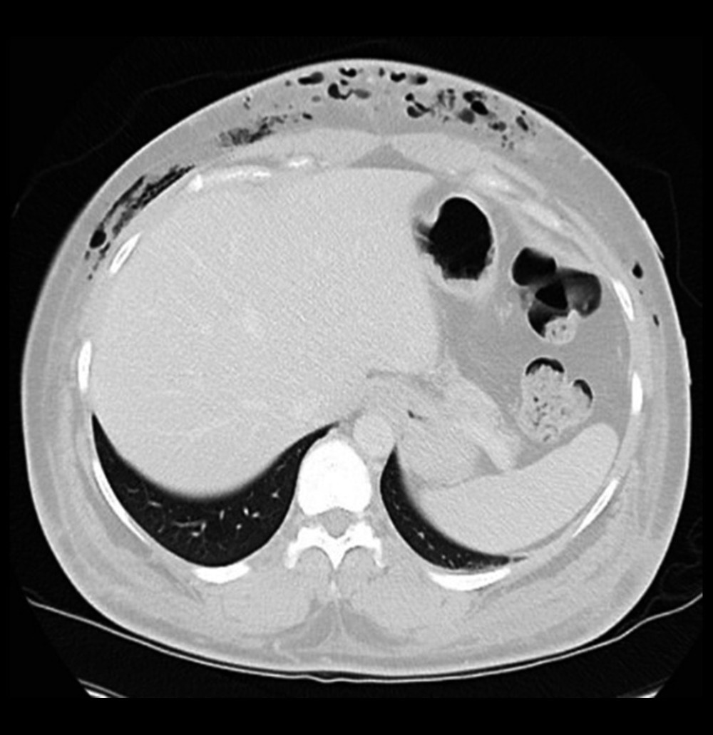 Cross sectional computerized tomography demonstrating subcutaneous emphysema in the anterior abdomen.
