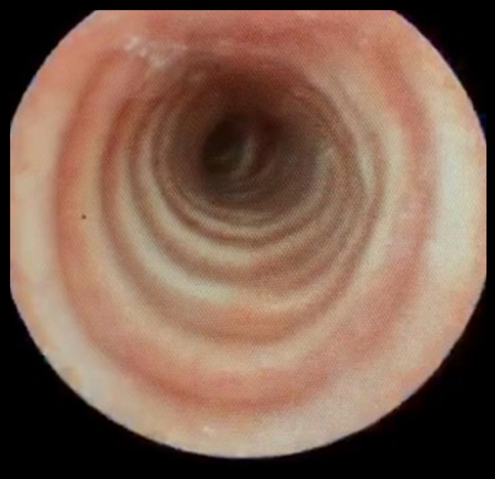 Flexible tracheoscopy and bronchoscopy demonstrating intact tracheal walls.