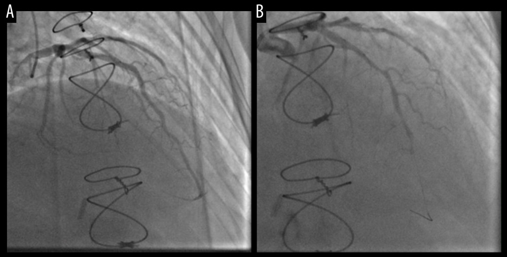 Coronary angiography comparison. (A) Coronary angiogram from 9 months prior to presentation, showing mild cardiac allograft vasculopathy without any significant stenosis. (B) Coronary angiogram from the current presentation, showing diffuse cardiac allograft vasculopathy that has progressed significantly from the prior angiogram. The apical portion of the left anterior descending artery is completely occluded. Multiple attempts at balloon angioplasty were unsuccessful.