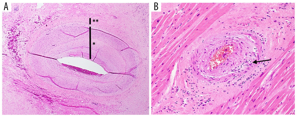 Severe cardiac allograft vasculopathy. (A) Proximal left anterior descending artery; concentric proliferation of the intima (*) that spares the elastic lamina (**) (Hematoxylin and eosin staining [H&E], 40× magnification). (B) Intramyocardial artery with intimal proliferation and sparse mural chronic inflammation (arrow) (H&E, 200× magnification).