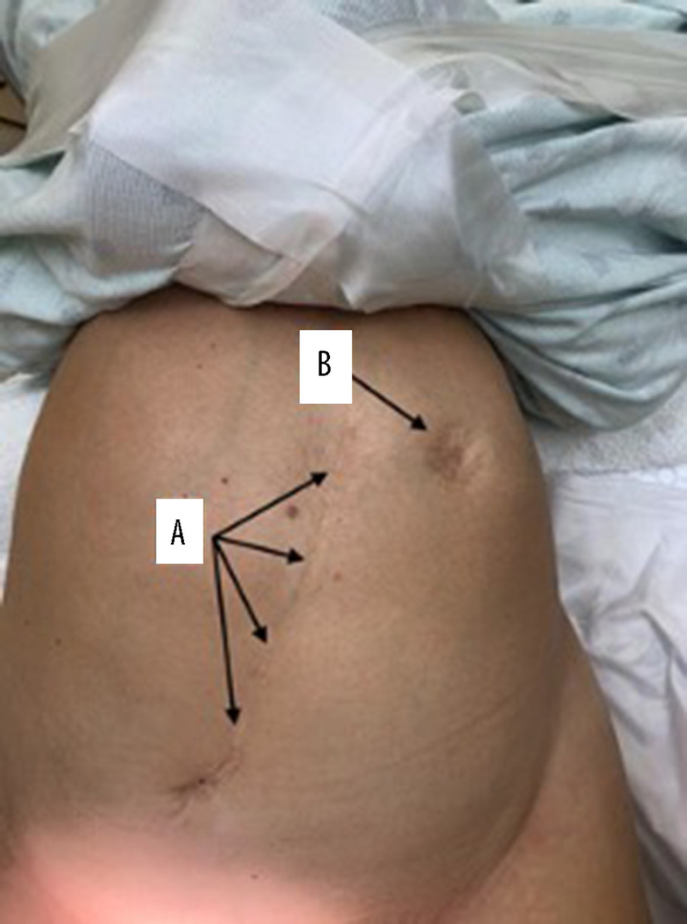 Preoperative photo showing abdominal distention and previous laparotomy scar (labeled A), and previous colostomy site in the left upper quadrant (labeled B).