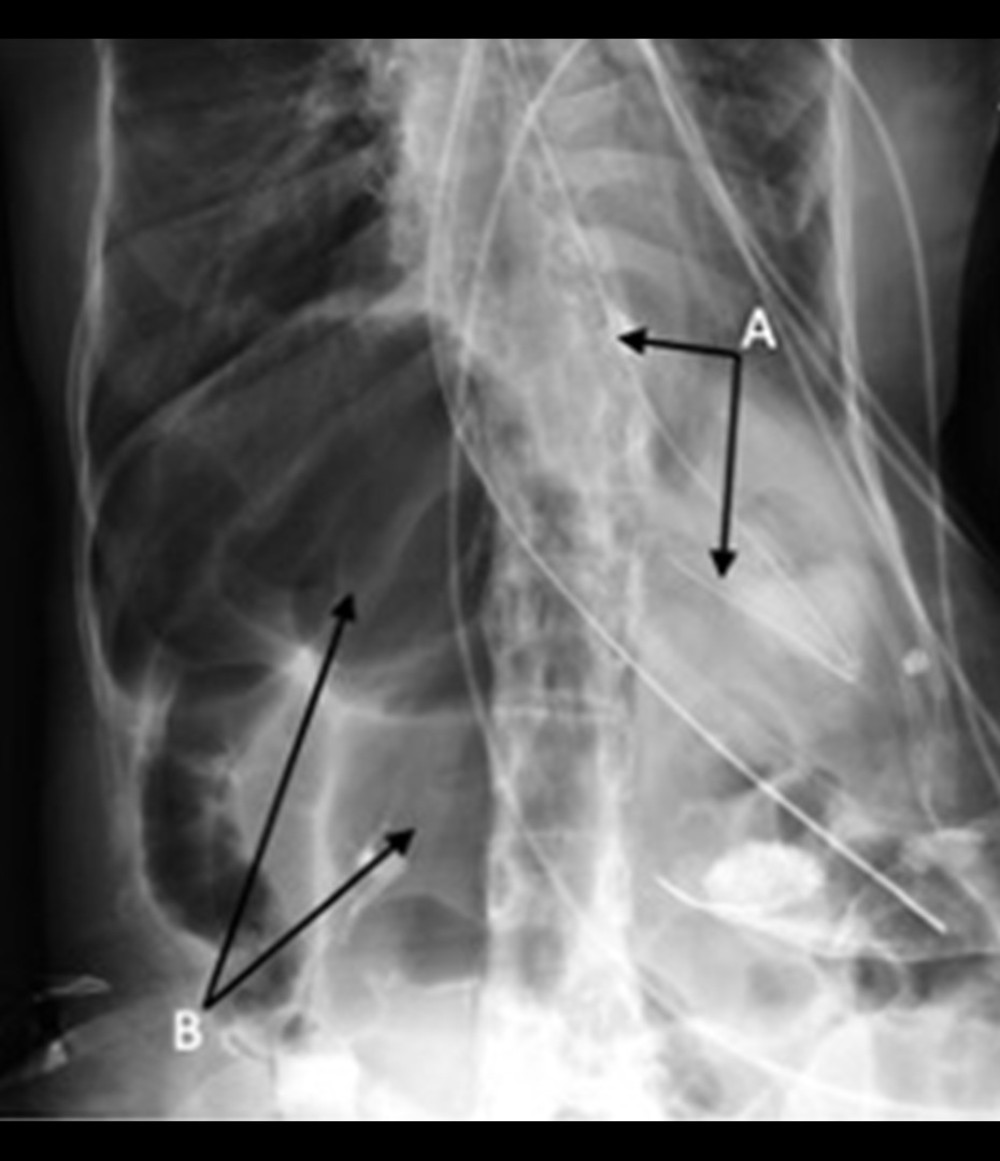 Abdominal X-ray on admission showing nasogastric tube in the left upper quadrant (labeled A), and distended cecum in the right lower quadrant (labeled B).