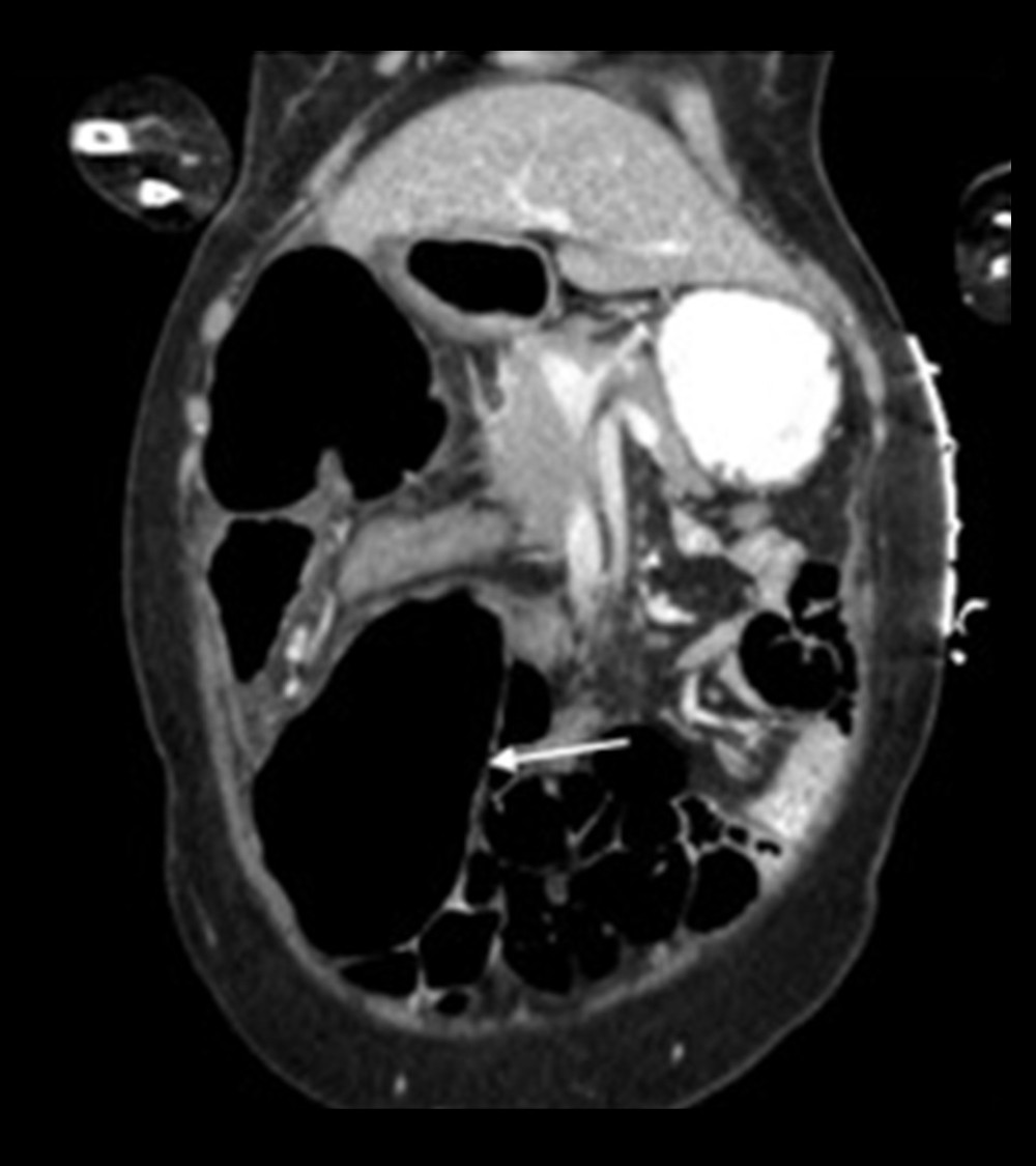 Coronal CT showing distended bowel in right lower quadrant (arrow).