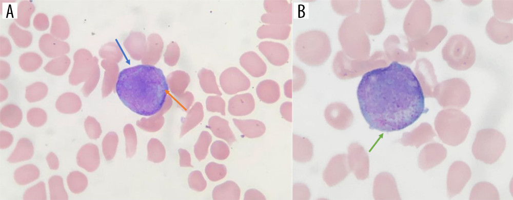 Peripheral blood smear images A and B, demonstrating increased promyelocytes (A, blue arrow), with some hyper granularity with azurophilic granules (B, green arrow) with Auer rods visualized (A, orange arrow).