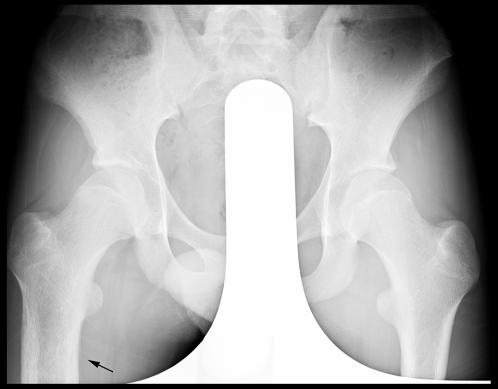 Initial plain radiograph taken at a local clinic showed marked cortical thickening of the right proximal femur (black arrow).