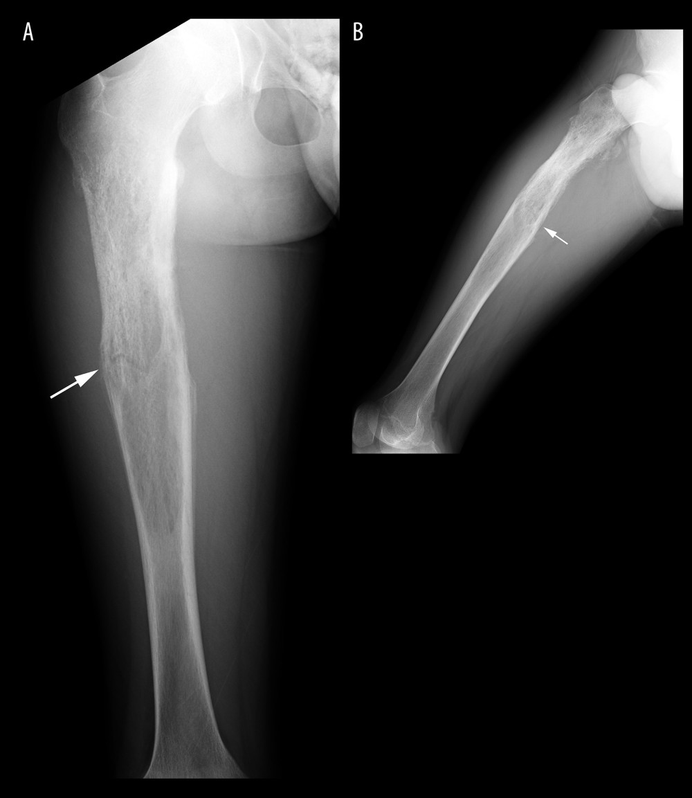 Plain radiograph anteroposterior view (A) and lateral view (B) of the right femur taken 6 months later. An expansion of the femoral shaft with irregular cortical thickening and a pathological fracture (white arrow) at the mid-shaft were observed.