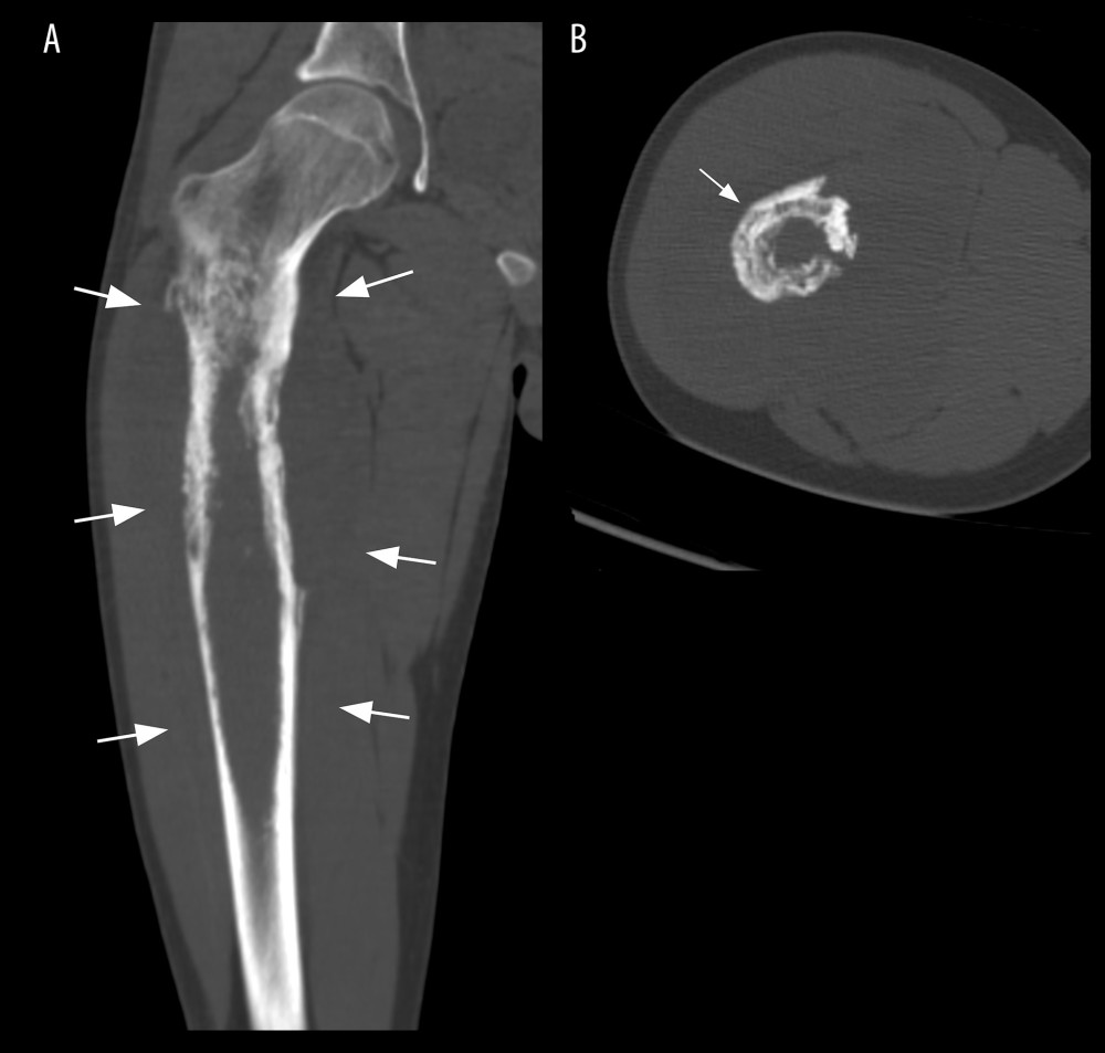 Coronal (A) and axial (B) section of computed tomography scanning revealed expansion of the femoral shaft and cortical irregularity (white arrow).