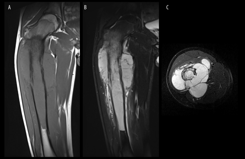 Extra-osseous mass showing homogenous iso-intensity is seen on magnetic resonance imaging coronal T1-weighted image (A) and homogenous high-intensity on coronal (B) and axial (C) short-T1 inversion recovery (STIR) images. Lobular growth of the tumor is also noticeable on STIR images.