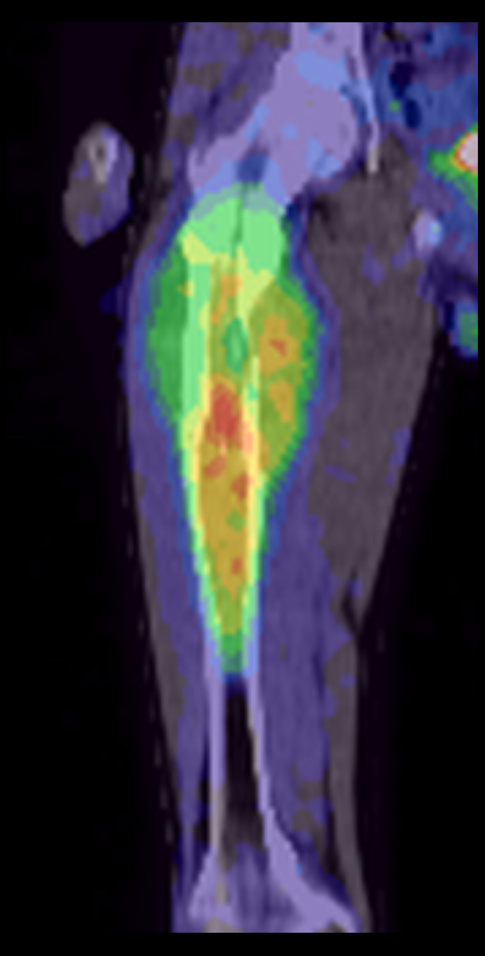 Positron emission tomography/computed tomography scanning showed high accumulation of 18F-fluorodeoxyglucose at the femoral lesion.