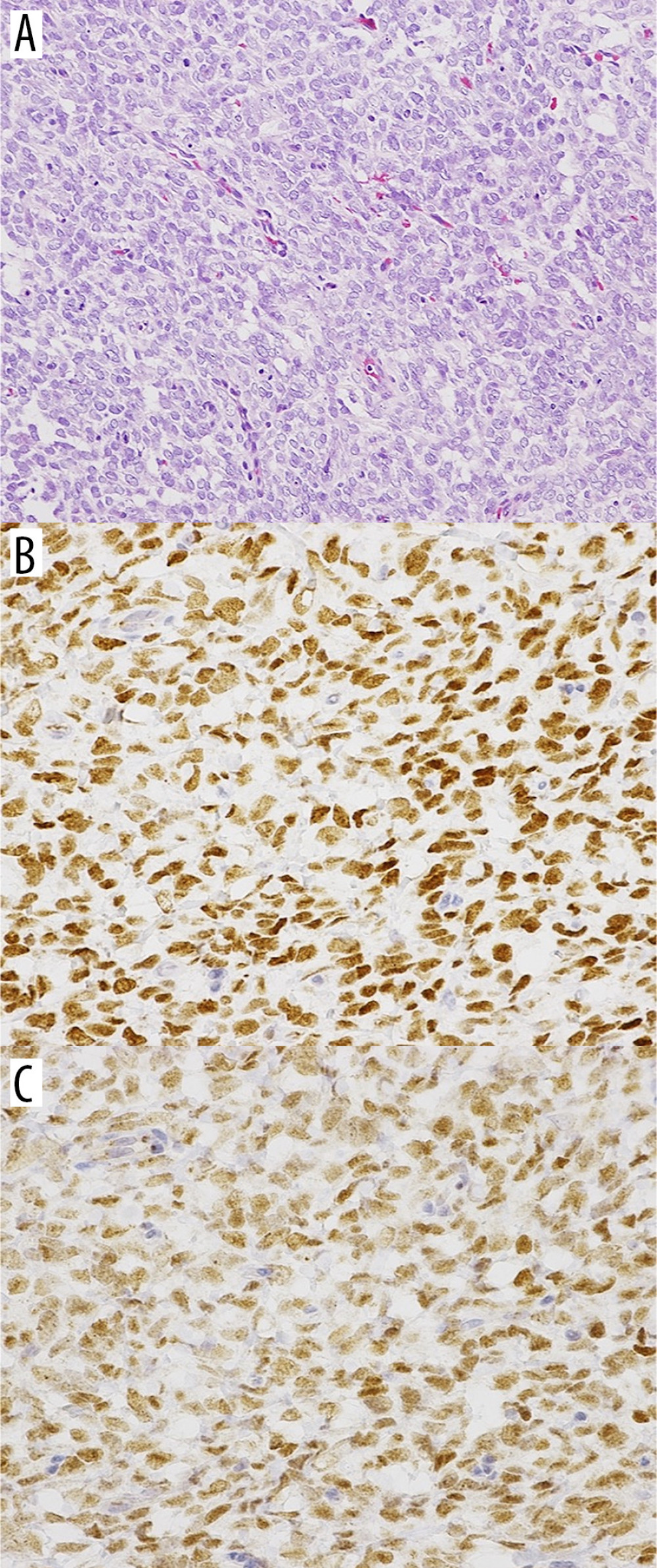 (A) Histological appearance of the biopsy specimen with hematoxylin-eosin staining. The tumor was composed of small round and short spindle cells with a sheet-like arrangement. (B) Immunohistochemical staining revealed that the tumor cell nuclei were diffusely positive for BCOR. (C) Tumor cell nuclei were also positive for CCNB3.