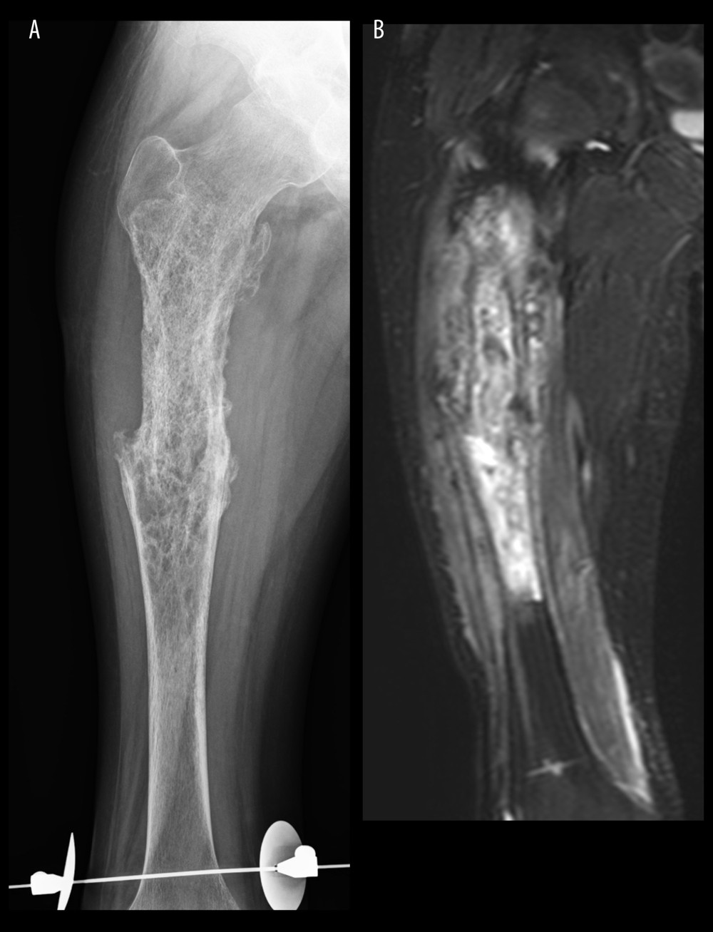 Plain radiography after preoperative chemotherapy. (A) Bone repair and union of the pathologic fracture are estimated. (B) Marked shrinkage of the tumor was obvious on magnetic resonance imaging.
