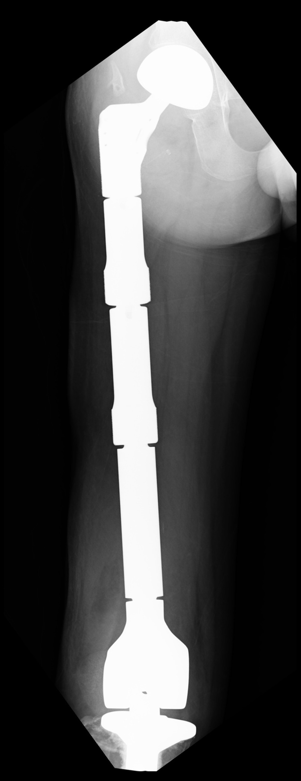 Wide resection of the tumor and total prosthetic femoral replacement were conducted.