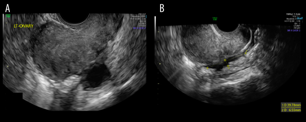Vaginal ultrasound. Uterine forced retroflexion with signs of diffuse adenomyosis and a typical endometrioma on the left ovary (20 mm) (A). A nodule of infiltrating deep endometriosis in the rectosigmoid region (B).