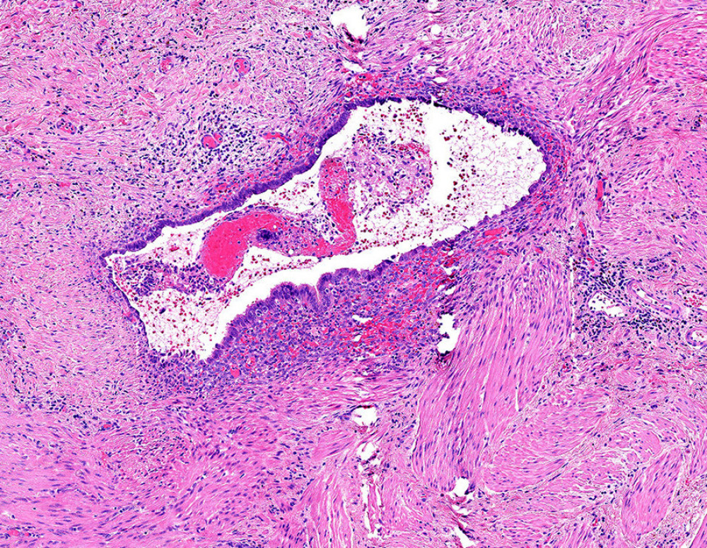 A photomicrograph of the histopathology of the ureter showing a focus of endometriosis. A dilated endometrial gland is shown, surrounded by stroma. No cytological atypia is seen and there are no other features of malignancy. Hematoxylin and eosin staining; magnification ×40.