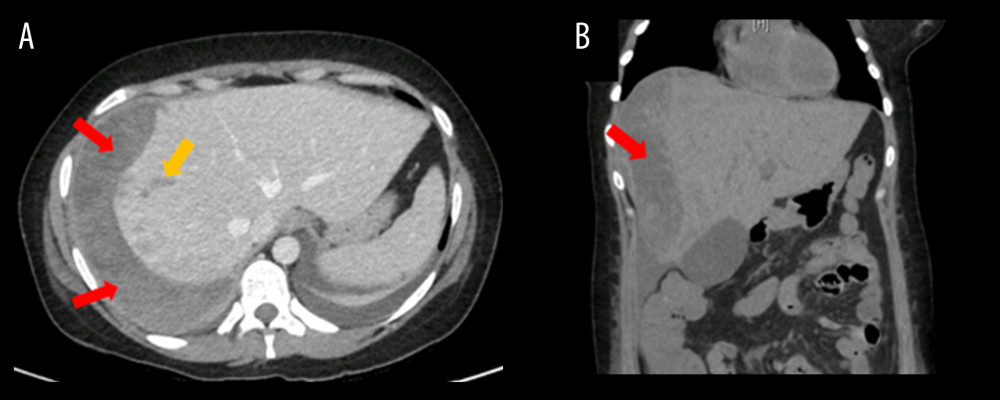 Abdomen-pelvis computed tomography scan without contrast. Axial plane (A); coronal plane (B). Acute-subacute hepatic subcapsular hematoma of 185CC×165AP×50T mm (red). Several liver injuries, the largest one 55 mm long (yellow). Moderate amount of fluid in the subhepatic, right parietocolic, and pelvic areas.