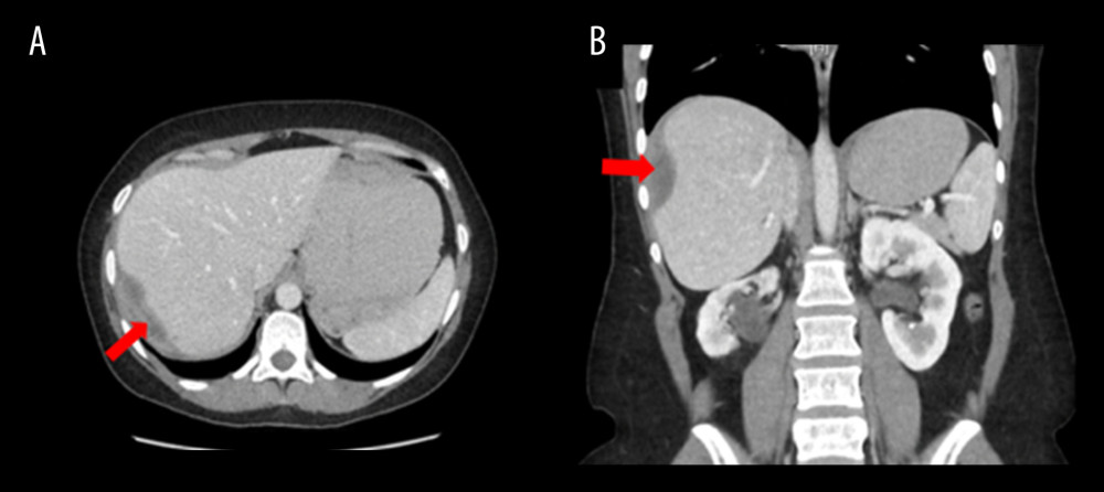 Abdomen-pelvis computed tomography (CT) scan without contrast. Axial plane (A); coronal plane (B). Significant radiological improvement of hepatic subcapsular hematoma, compared with previous CT scan results; dimensions 77.6CC×45AP×16T. No free fluid.
