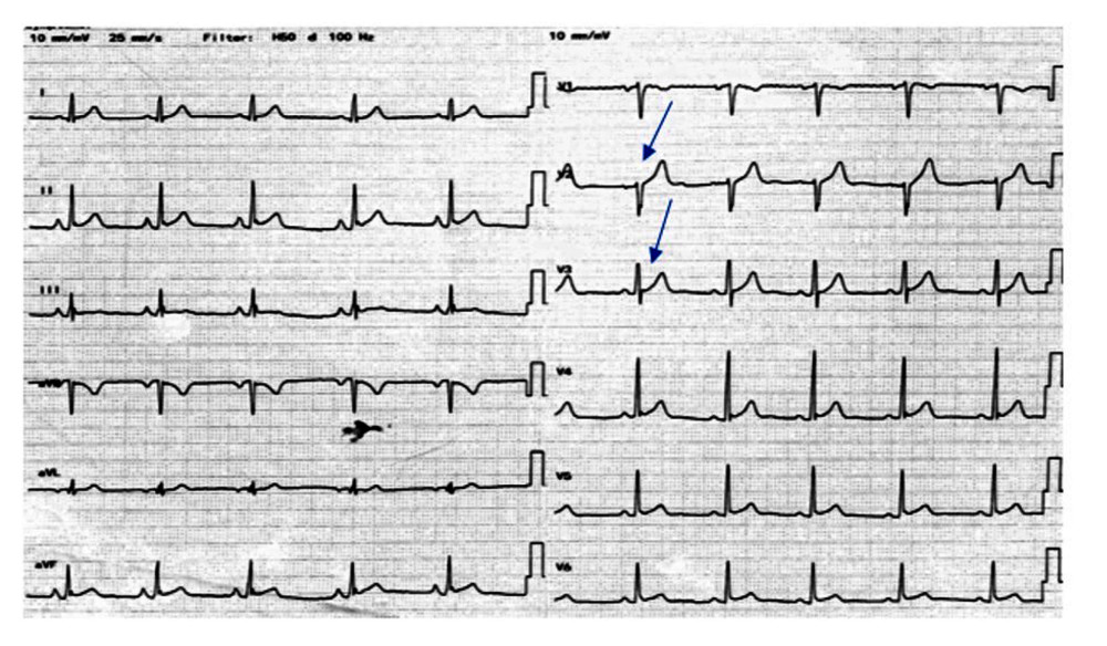 12-lead admission electrocardiogram (ECG). The blue arrows show benign early repolarization and minimal ST-segment elevation in leads II and III, V2–V6 of 1 mm with no reciprocal changes, and PR segment elevation in lead aVR.