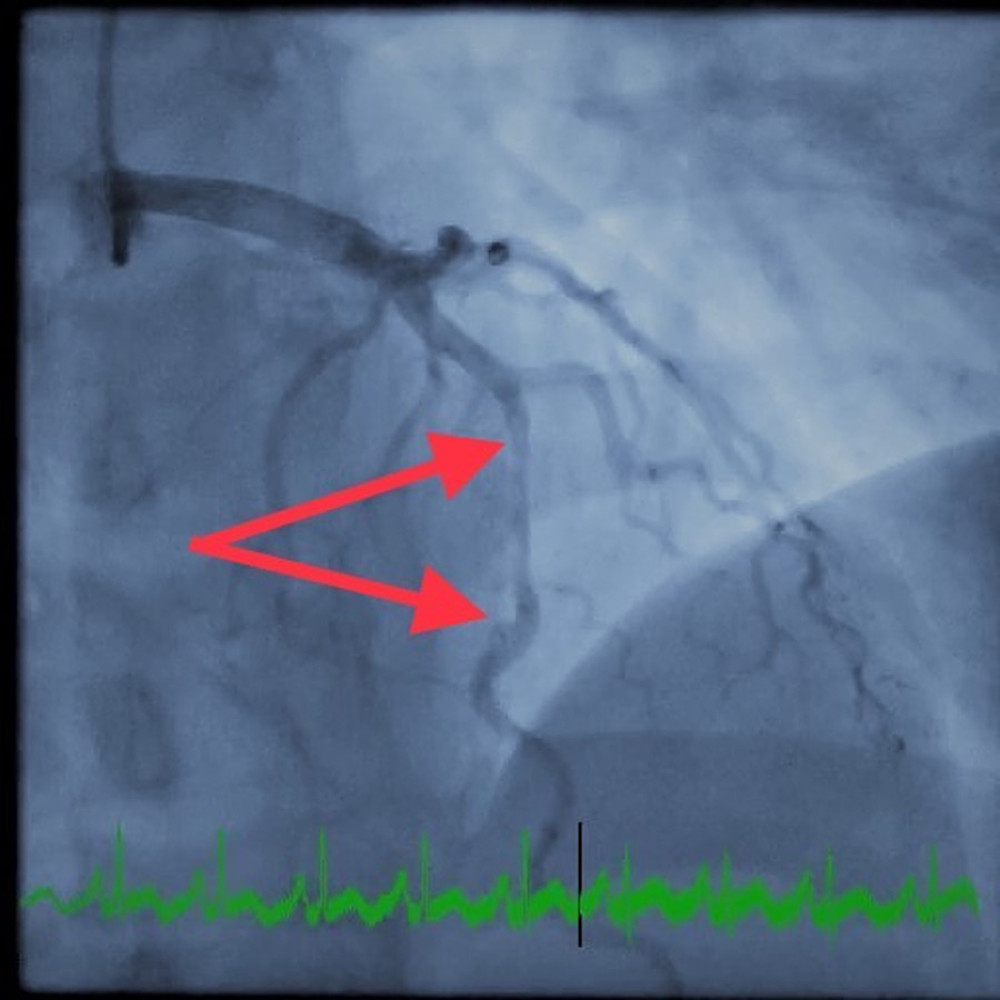 Diagnostic coronary angiogram (cranial view) of the left anterior descending artery. The 2 red arrows demarcate the span of the attenuated portion of the left anterior descending artery diameter during systole.