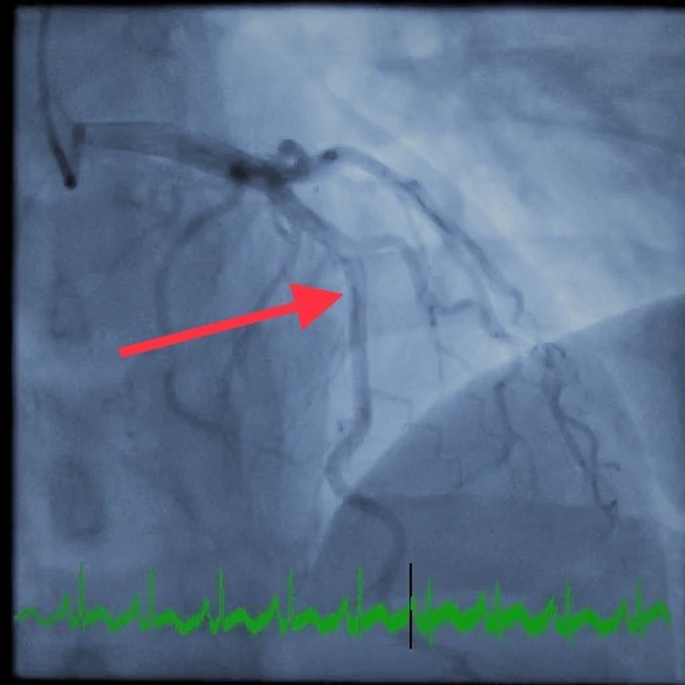 Diagnostic coronary angiogram (cranial view) of the left anterior descending artery. The red arrow shows the total intravascular diameter of the left anterior descending artery without narrowing during diastole.