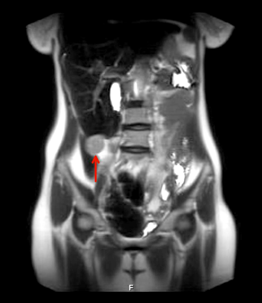 T1-weighted magnetic resonance imaging in the coronal plane of the abdominal and pelvis shows a subhepatic tumor (arrow).