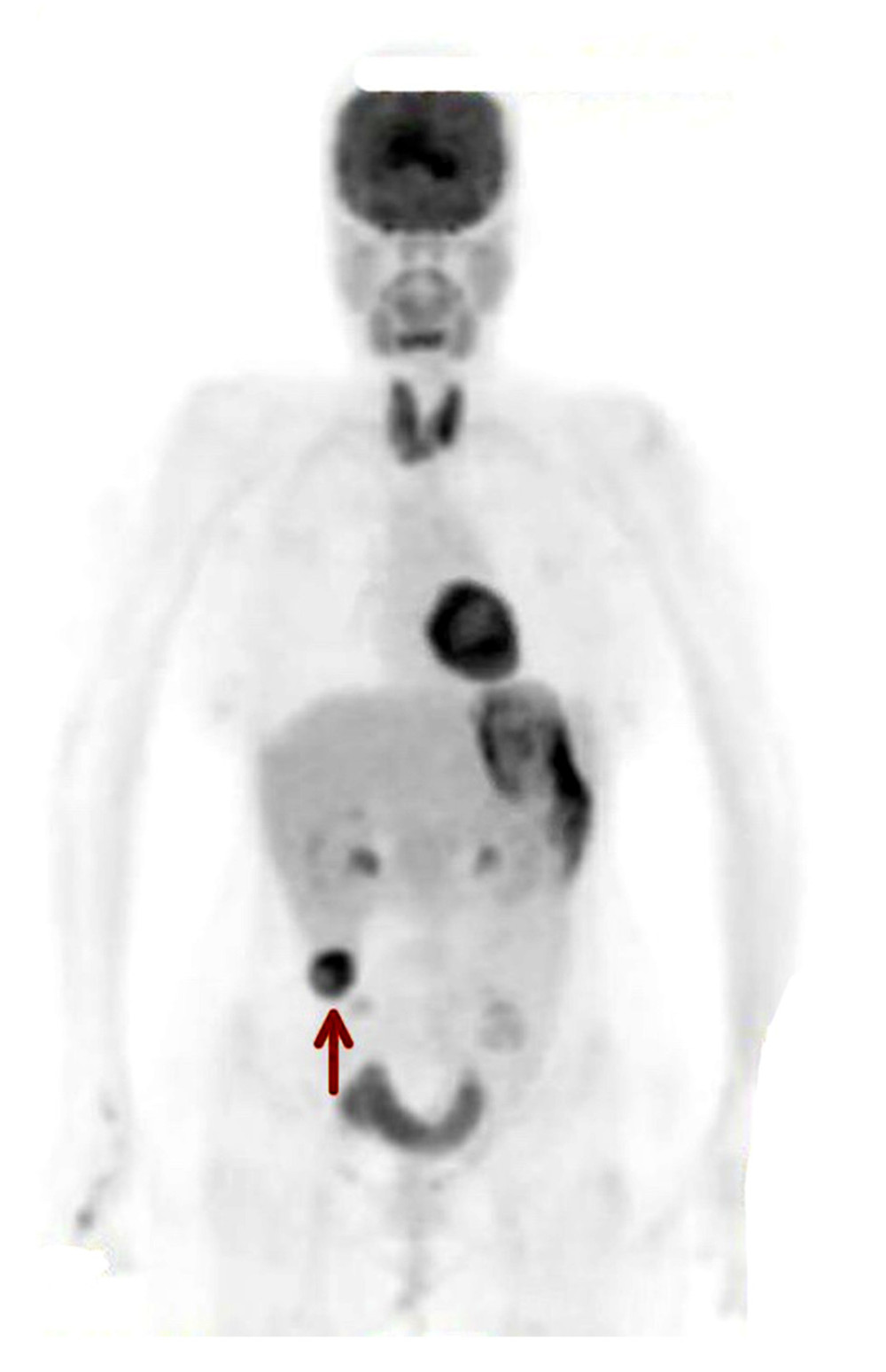 A whole-body positron emission tomography scan shows a hypermetabolic subhepatic tumor (arrow).
