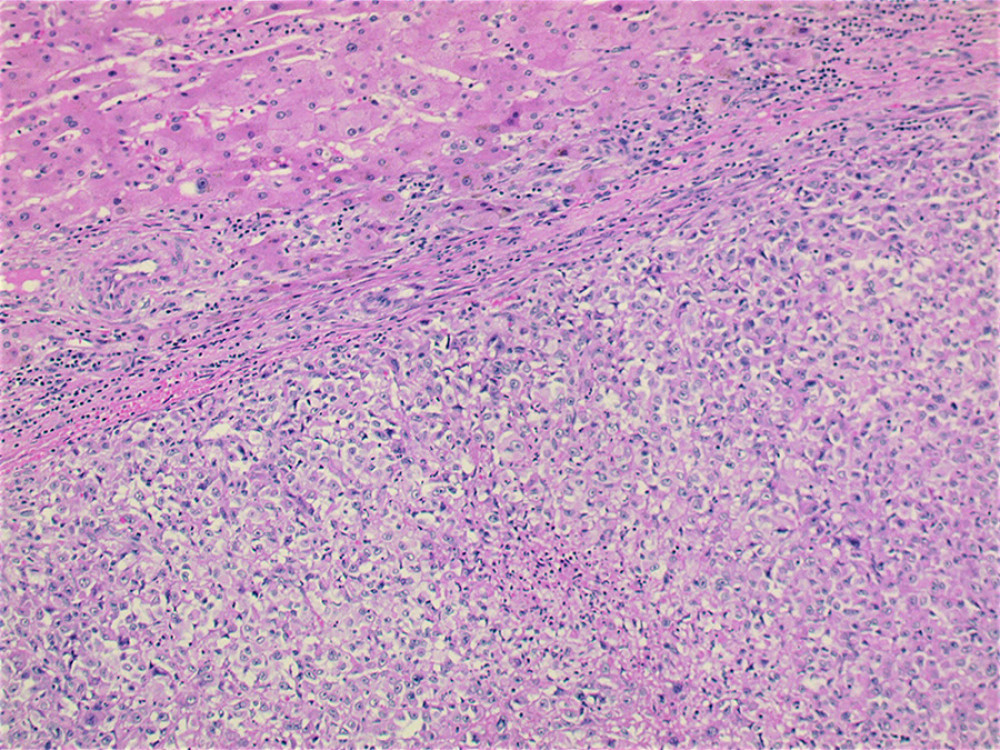 Medium-power view showing the sheets of tumor cells adherent to the liver capsule with no parenchymal invasion (hematoxylin and eosin, ×100).