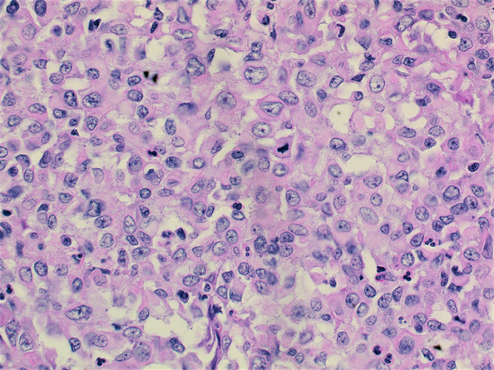 High-power view of the epithelioid tumor cells with scattered inflammatory cells along with a mitotic figure (hematoxylin and eosin, ×200).