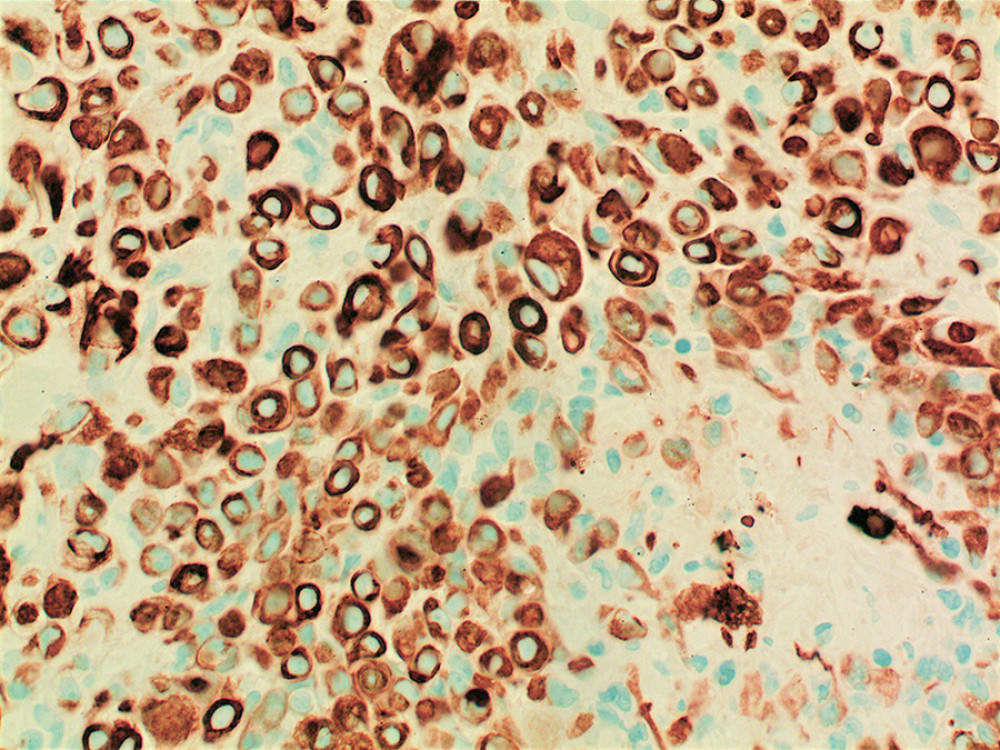 CK 5/6 immunohistochemistry. Strong cytoplasmic positive staining for CK 5/6 is also noted.