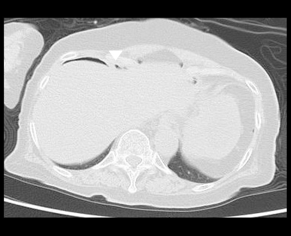 Abdominal computed tomography axial, showing a small amount of free air in the abdominal cavity and on the surface of the liver.