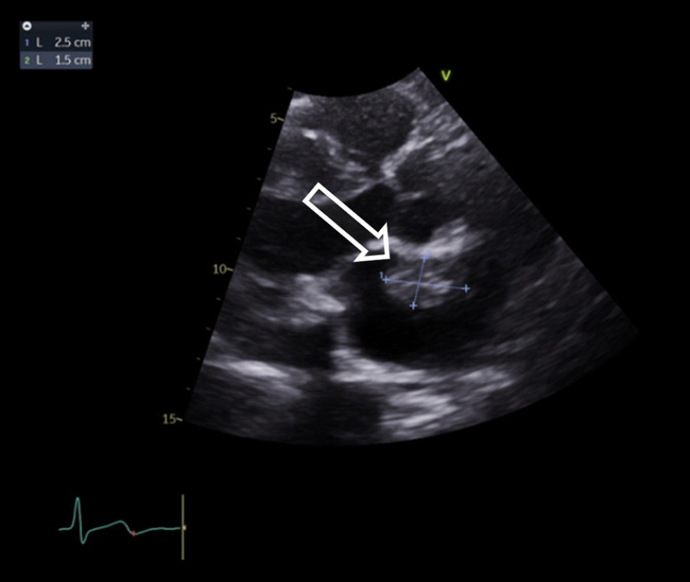 Transthoracic echocardiogram showing 2.5×1.5 cm fixed mass in the fossa ovalis, consistent with cardiac myxoma.