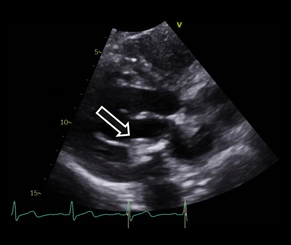 Transthoracic echocardiogram showing a 1.3-cm mobile mass in the posterior chordae, consistent with calcification.