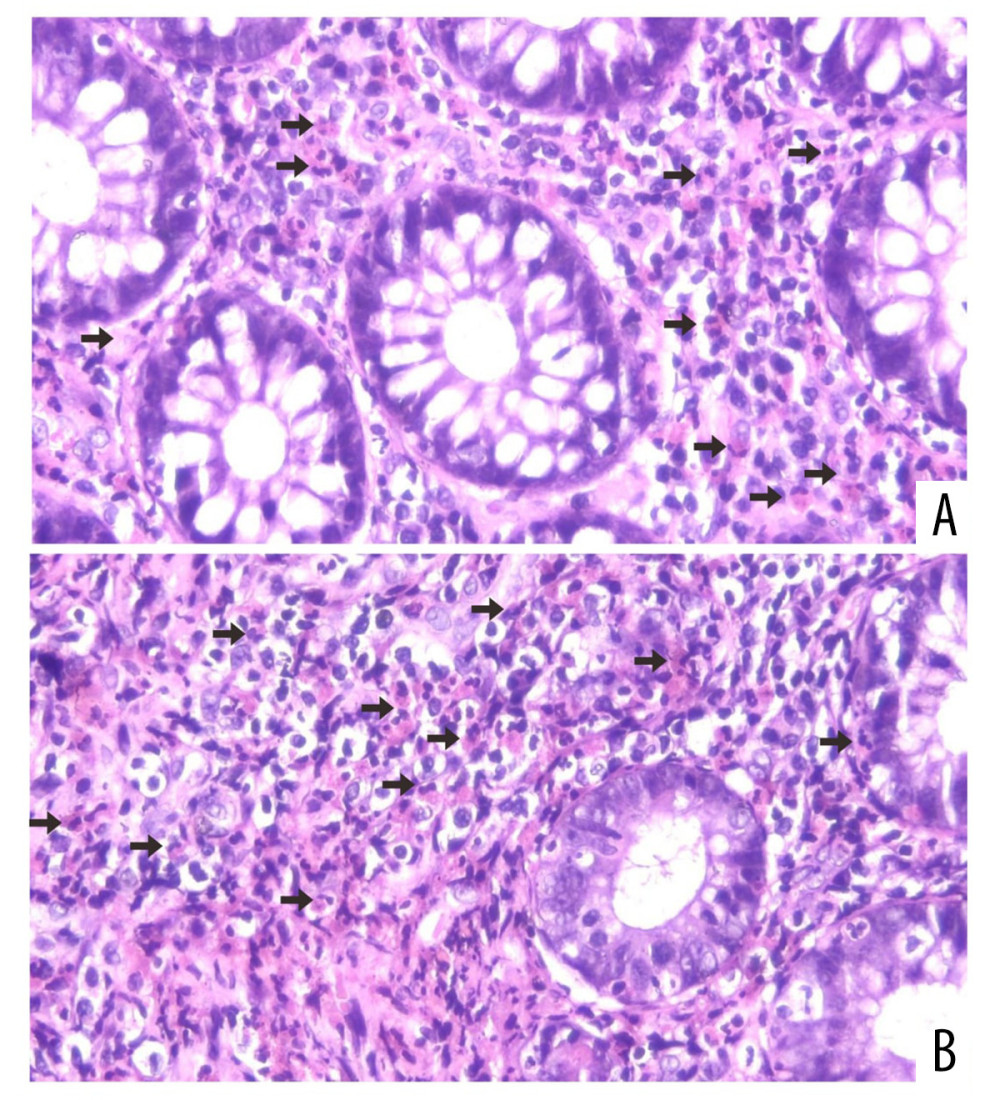 Endoscopic biopsy showing (A) diffuse infiltration of inflammatory cells in the form of lymphocytes, histiocytes, and numerous eosinophils (arrows) in the gastric tissue stroma. (B) The lamina propria of gastric mucosa is occupied by numerous eosinophils (arrows). There are more than 25 eosinophils per high power field (hematoxylin and eosin, ×400).