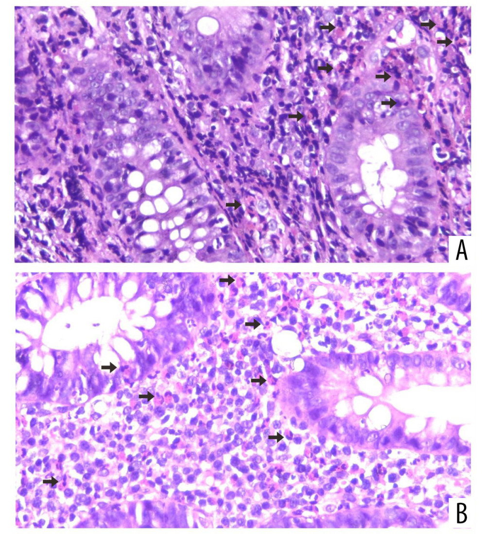 Endoscopic biopsy showing (A) the lamina propria of gastric mucosa is occupied by numerous of eosinophils (arrows). (B) Biopsy shows diffuse infiltration of inflammatory cells in the form of lymphocytes, histiocytes, and numerous eosinophils (arrows) in the gastric tissue stroma. There are more than 40 eosinophils per high power field (hematoxylin and eosin, ×400).
