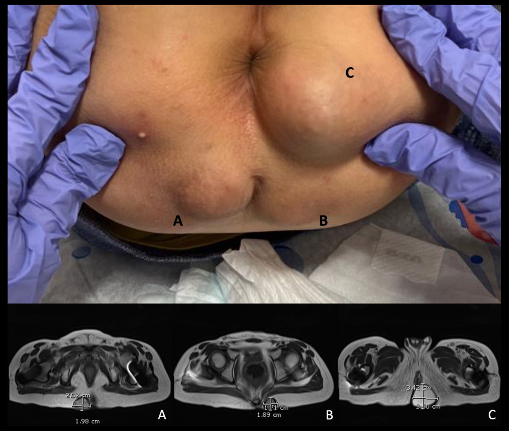 Gross and MRI images of 3 perianal cystic masses. A) Lesion located to the right of the coccyx. B) The most superior lesion located to the left of the coccyx. C) The largest, most inferior lesion located in the left perirectal region of the buttocks.