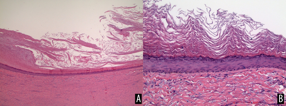 Pathological examination of the perianal cystic masses. (A) H&E stain at 40× magnification displaying fibrotic cystic wall with a keratinizing stratified squamous lining. (B) H&E stain at 200× magnification displaying epithelial lining of one of the cysts.