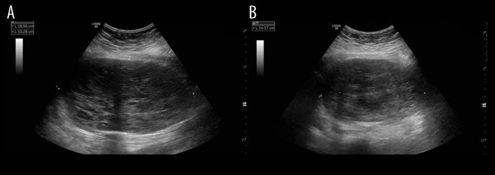 External transpelvic ultrasound of a heterogenous, predominantly solid pelvic mass. (A) Sagittal view of the mass. measuring 18.6×10.3 cm. (B) Transverse view of the mass, with its height measuring 14.4 cm.