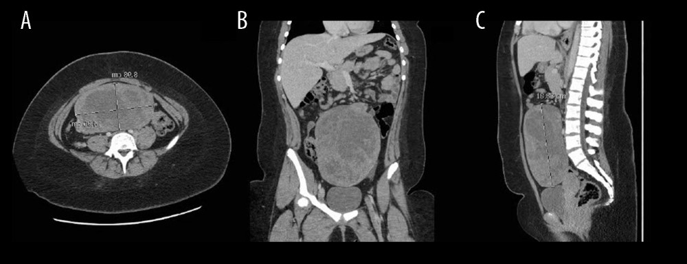 Computed tomography (CT) abdomen and pelvis with contrast. (A) Axial view of CT abdomen and pelvis of the juvenile granulosa cell tumor measuring 8.98×16.96 cm. (B) Coronal view of CT abdomen and pelvis of the juvenile granulosa cell tumor. (C) Sagittal view of CT abdomen and pelvis of the juvenile granulosa cell tumor with its height measured at 18.83 cm.