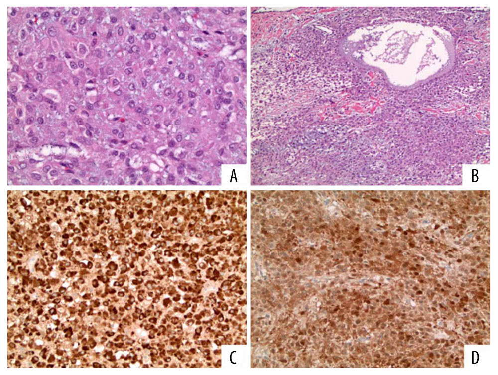 Photomicrographs of the diagnostic histopathology and immunohistochemistry of juvenile granulosa cell tumor of the ovary in a 12-year-old girl. (A) The histology of juvenile granulosa cell tumor shows cords of cohesive cells with eosinophilic cytoplasm and irregular cell nuclei, but no mitoses or necrosis. Hematoxylin and eosin (H&E). Magnification ×60. (B) Low-power histology of juvenile granulosa cell tumor shows sheets of tumor cells and some cystic areas. Hematoxylin and eosin (H&E). Magnification ×20. (C) Immunohistochemistry for calretinin shows positive brown staining of the cytoplasm of the tumor cells. Magnification ×40. (D) Immunohistochemistry for inhibin A shows positive brown staining of the nuclei of the tumor cells. Magnification ×60.