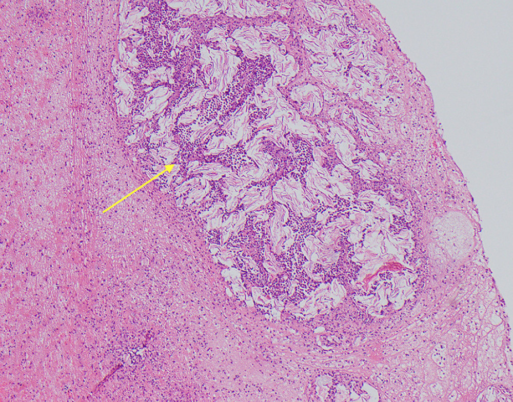 Microscopic view of peritoneal biopsy sample obtained from patient with vernix caseosa peritonitis showing dense neutrophilic inflammation (yellow arrow) surrounding keratin fragments with some fibrin.