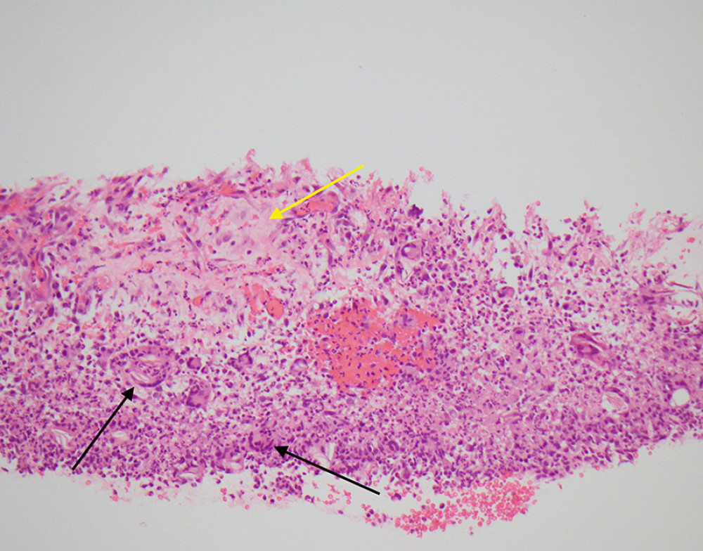 Inflammatory response near appendiceal serosa with features of vernix caseosa peritonitis. Keratinous material (yellow arrow) surrounded by granulomatous inflammation including foreign body – type giant cells (black arrows). Neutrophils, lymphocytes, and histiocytes are also seen.