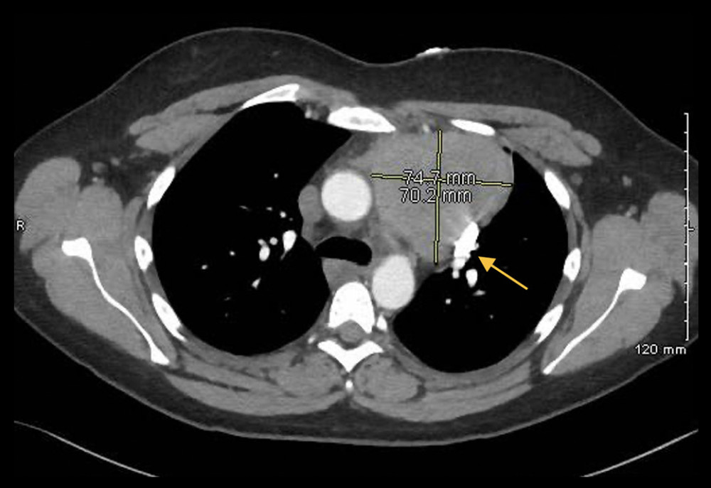 Computed tomography imaging conducted 1 month prior to surgical resection. Mass measuring 7.3×7.6 cm. Arrowhead indicates persistent left superior vena cava.