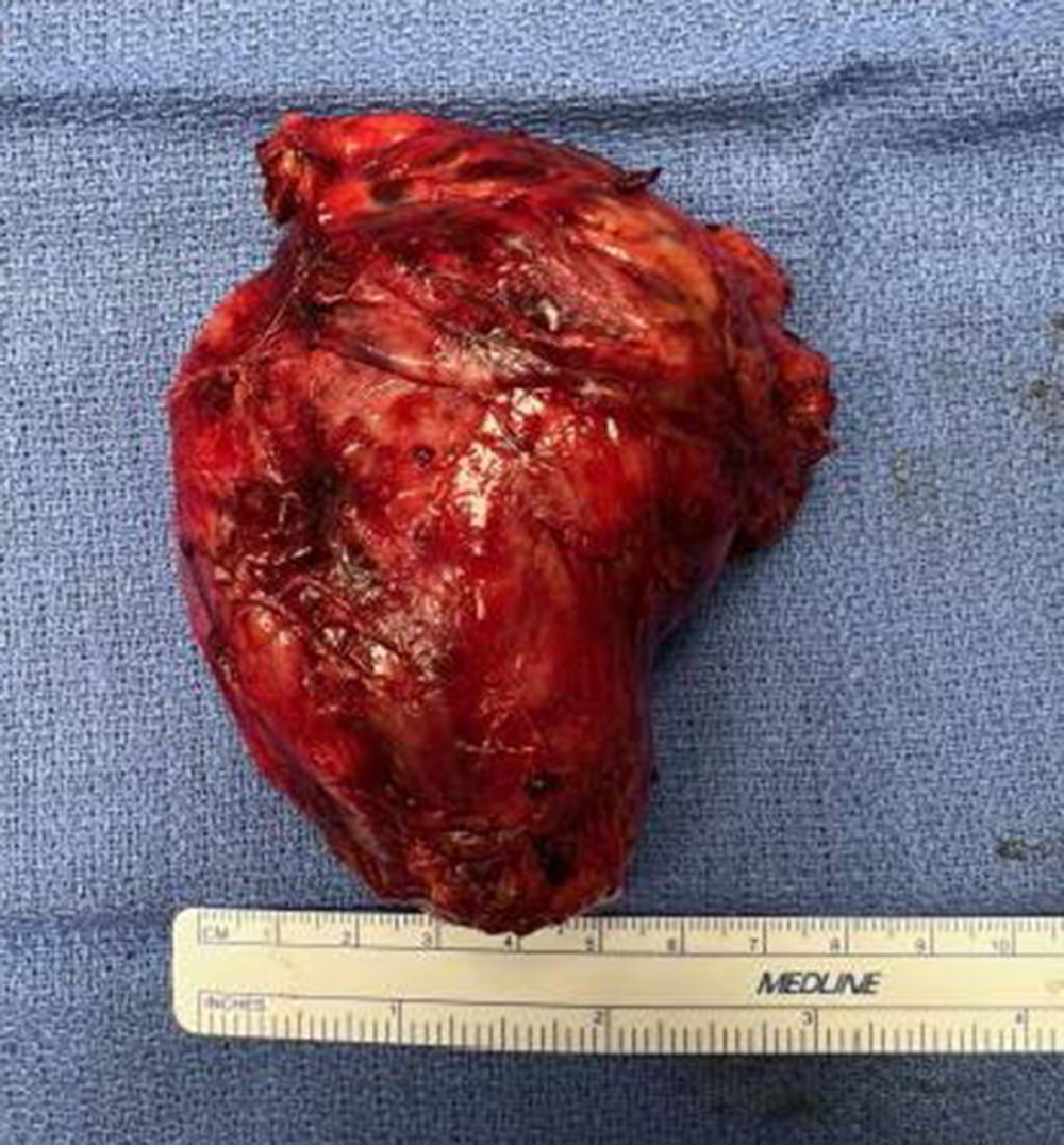 Aresected mediastinal mass measuring 9.3×6.5×3.4 cm was later found to be consistent with Castleman disease, hyaline-vascular type.
