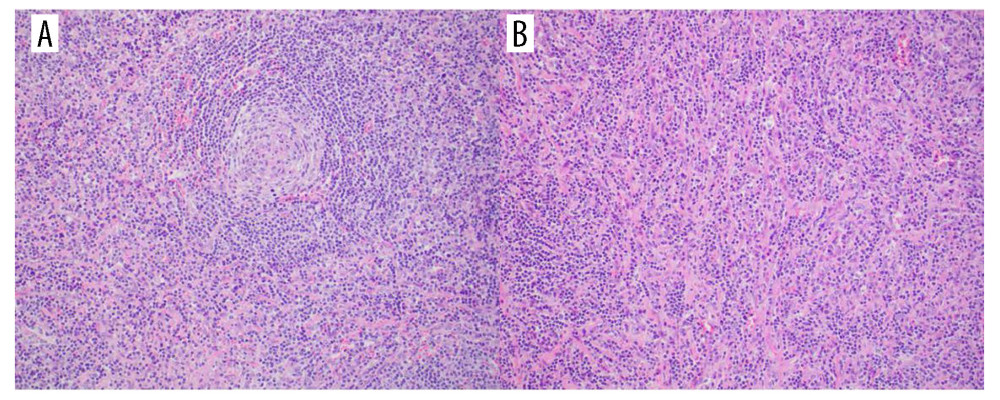 Features typical of the hyaline vascular variant of Castleman Disease are present. (A) Regressed germinal center surrounded by lymphocytes showing “onion skinning.” (B) Increased, hyalinized blood vessels. Hematoxylin and eosin stain, 200× magnification.