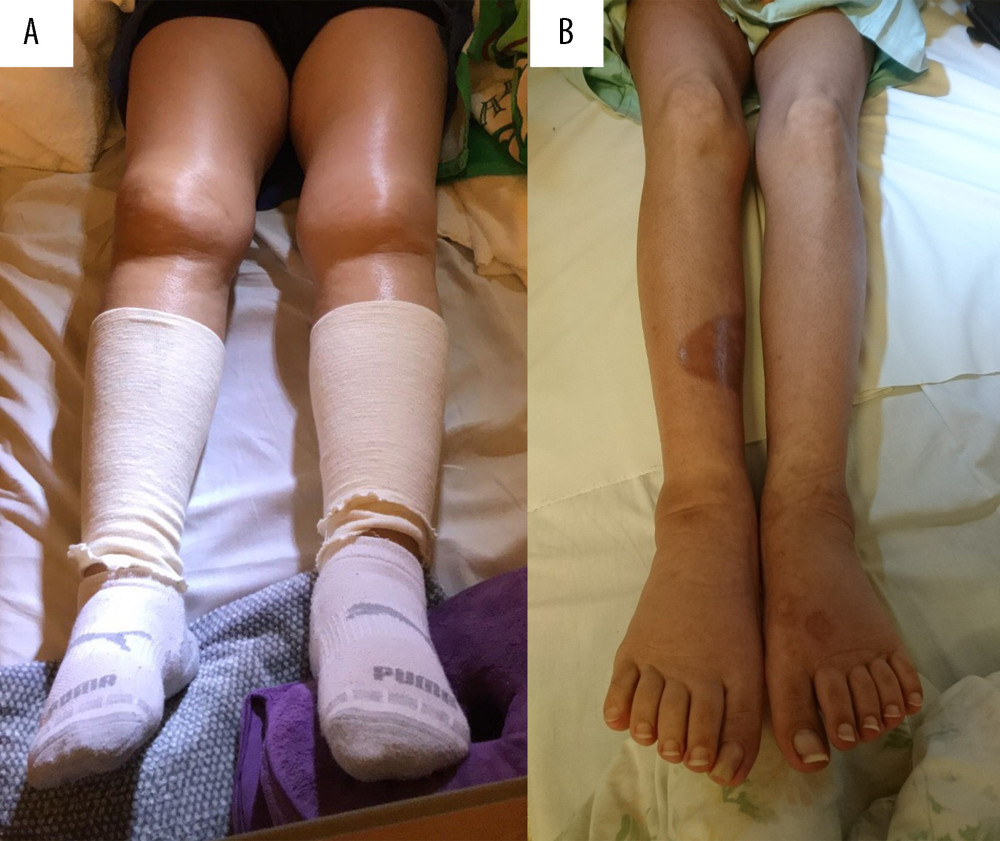 (A) On admission, the lower extremities were markedly edematous. (B) After inferior vena cava stenting, the edema of the lower extremities improved.