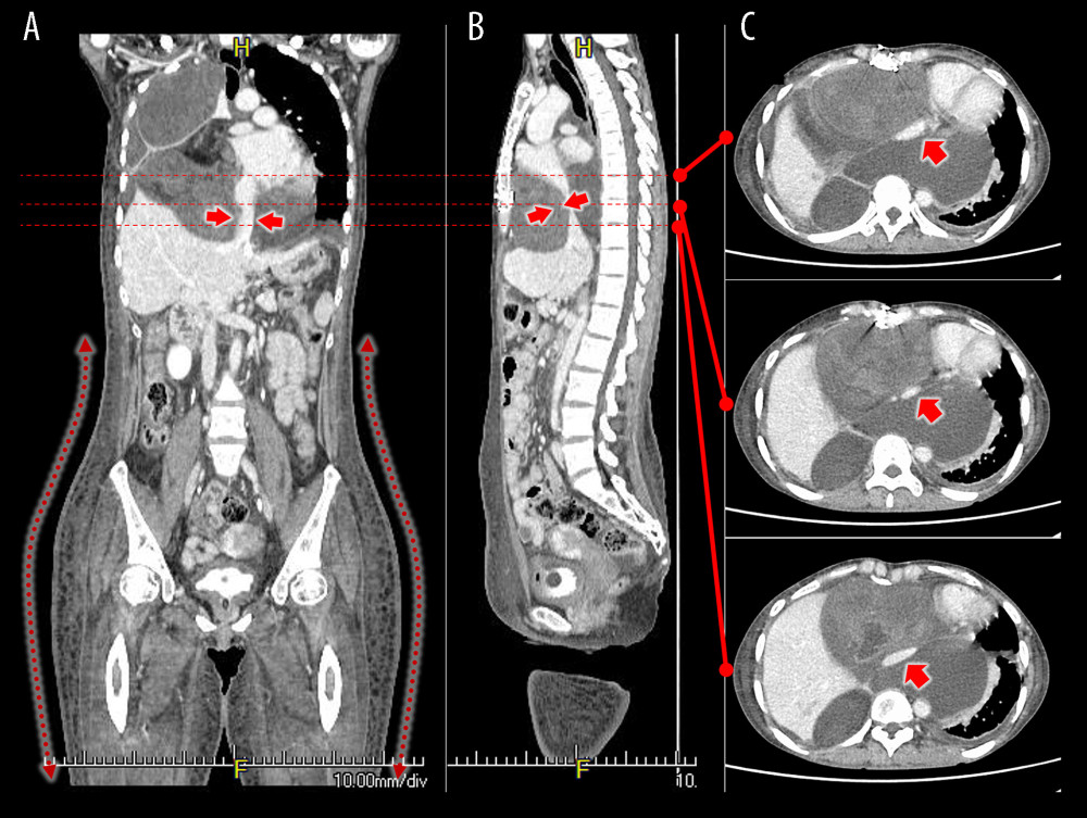 On admission, a CT of the thoracic to thigh showed a large tumor occupying the right thorax and extending into the upper part of the liver. The tumor had compressed the inferior vena cava and narrowed its lumen (arrows). Marked subcutaneous tissue edema was observed from the abdomen to both lower extremities (dotted arrows). (A) Coronal section; (B) Sagittal section; (C) Transverse section.