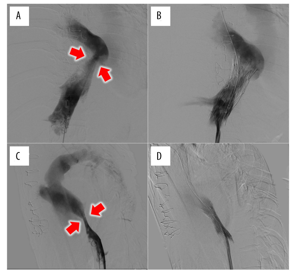 Inferior vena cava (IVC) arteriography showing stenosis of IVC due to a tumor in anterior view (A) and right side (B). After IVC stenting, the stenosis of IVC was dilated in anterior (C) and right side (D).