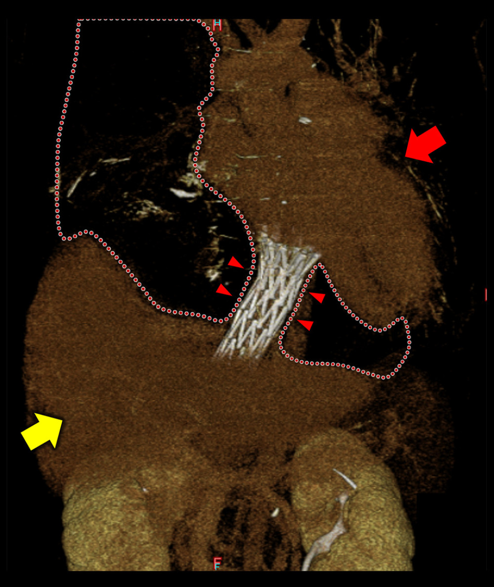 Three-dimensional images by enhanced CT show that the stent (triangle) was placed in the IVC between the liver (yellow arrow) and the heart (red arrow), sandwiched between the tumors (dotted area) in anterior view.
